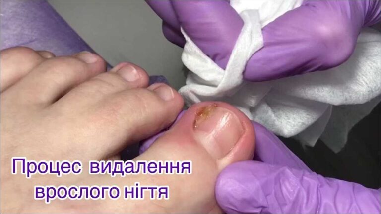 Лікування грибка нігтів на великих пальцях