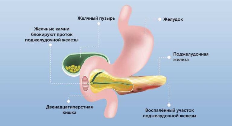 Як діагностувати та лікувати гострий панкреатит