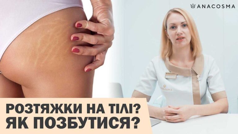 Як позбутися розтяжок після пологів