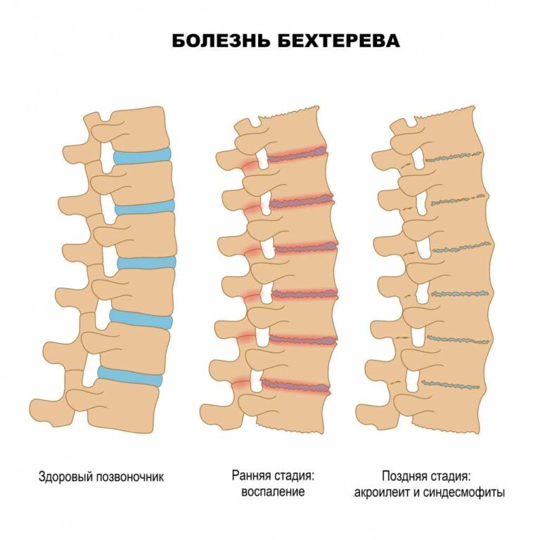 Хвороба Бехтерева: як розпізнати та лікувати