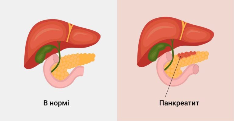 Що таке панкреатит: симптоми та лікування