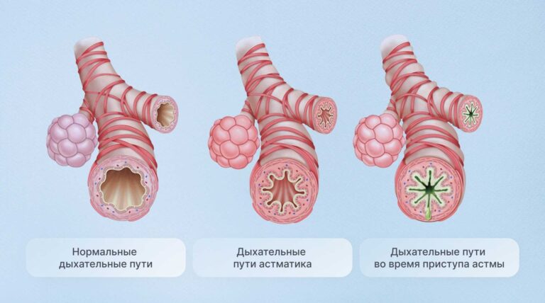 Симптомы бронхиальной астмы у взрослых и детей