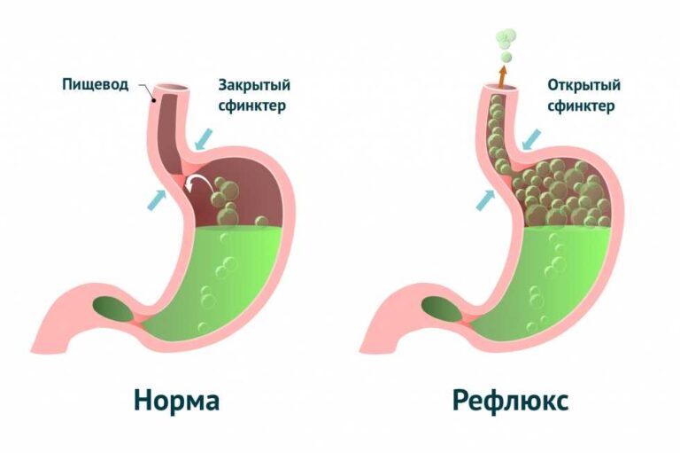 Як позбутися метеоризму після їжі