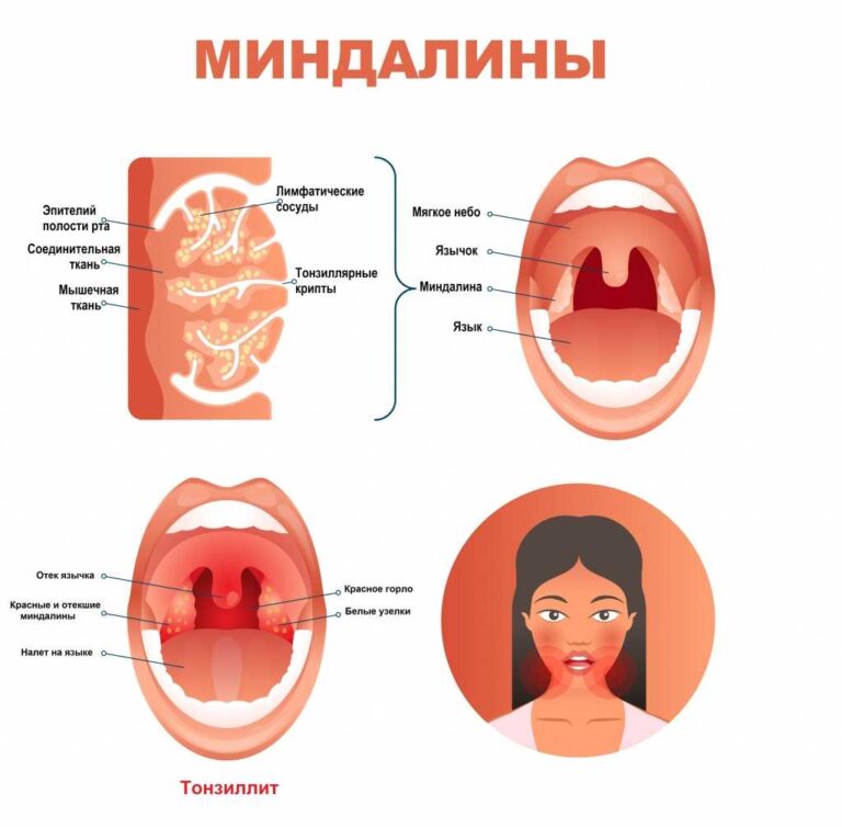 Причины и лечение хронического тонзиллита