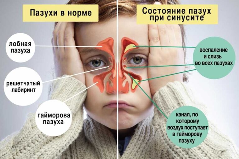Лечение хронического насморка у детей: эффективные методы