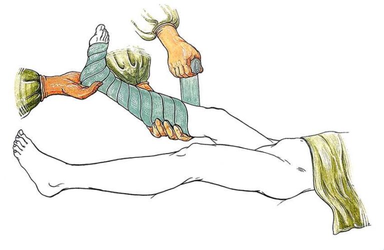 Лікування та профілактика варикозу