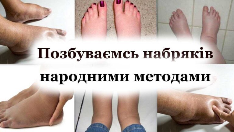 Як зменшити набряки на ногах
