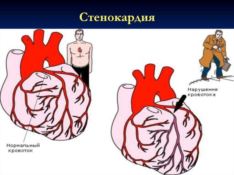 Симптоми та лікування стенокардії