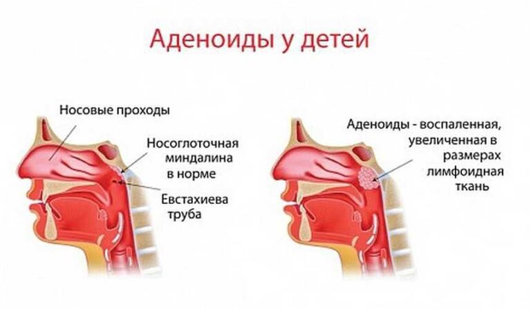 Чим лікувати аденоїди у дітей