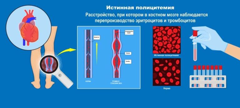 Що означає низький рівень тромбоцитів в загальному аналізі крові