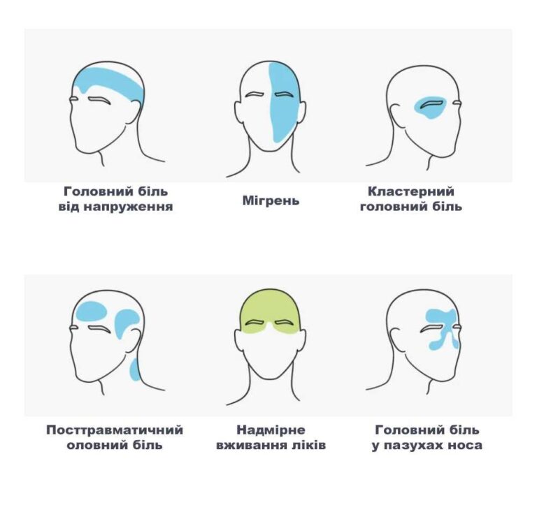 Як швидко позбутися головного болю