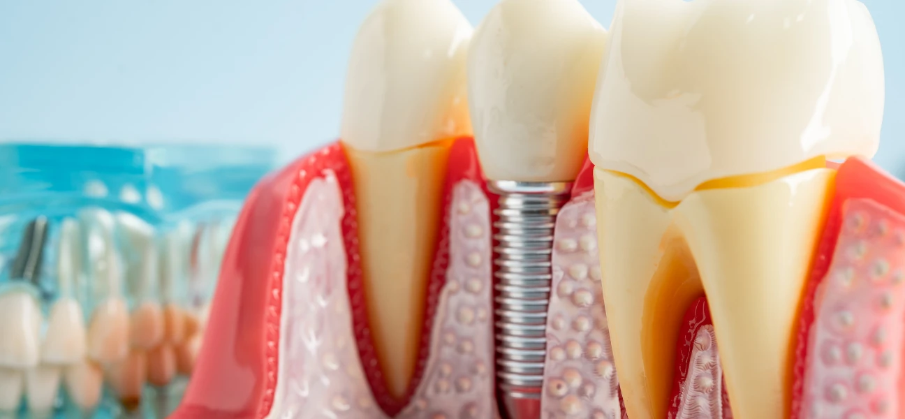 дентальна імплантація у Solovei Dental Clinic
