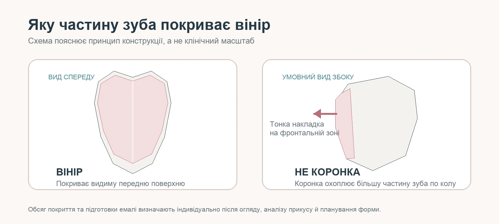 керамічні вініри для зубів