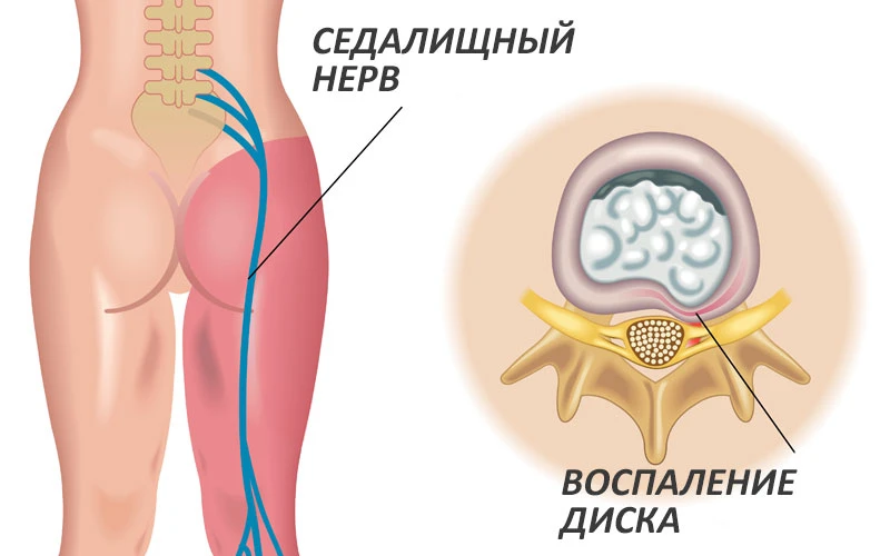Лечение поясничного радикулита